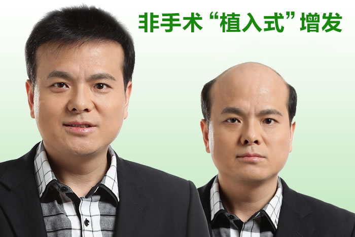 真人假发织发补发有什么优势？