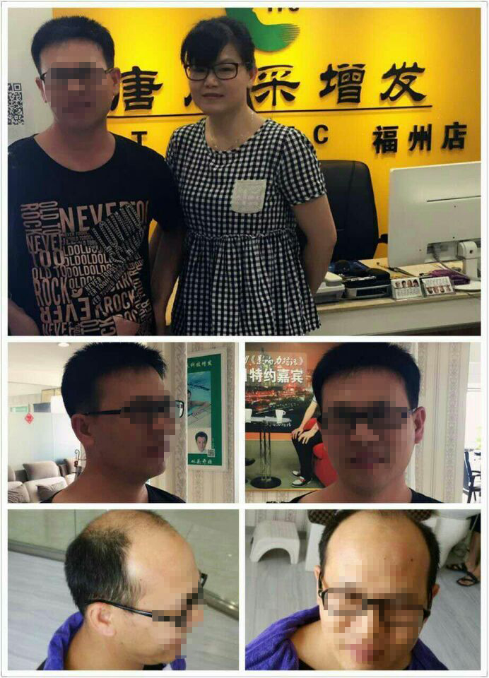 脱发后蓝瘦香菇 脱发后“蓝瘦、香菇”,那你还在等什么?