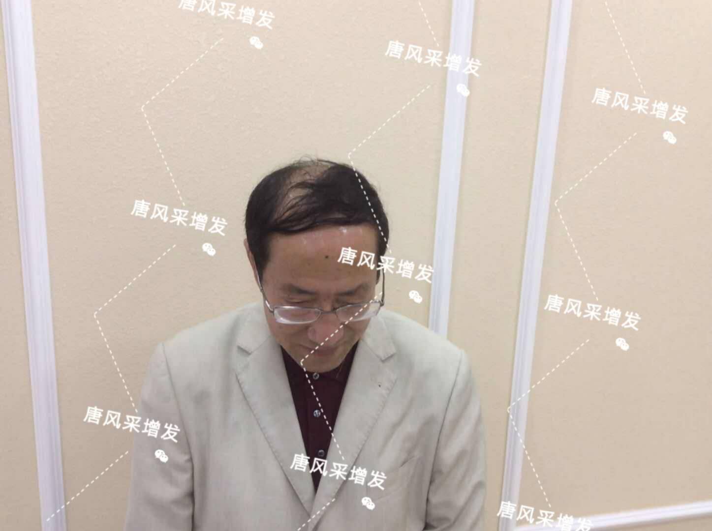 脱发秃顶成中年男人标配？唐风采增发让您风采始终如一