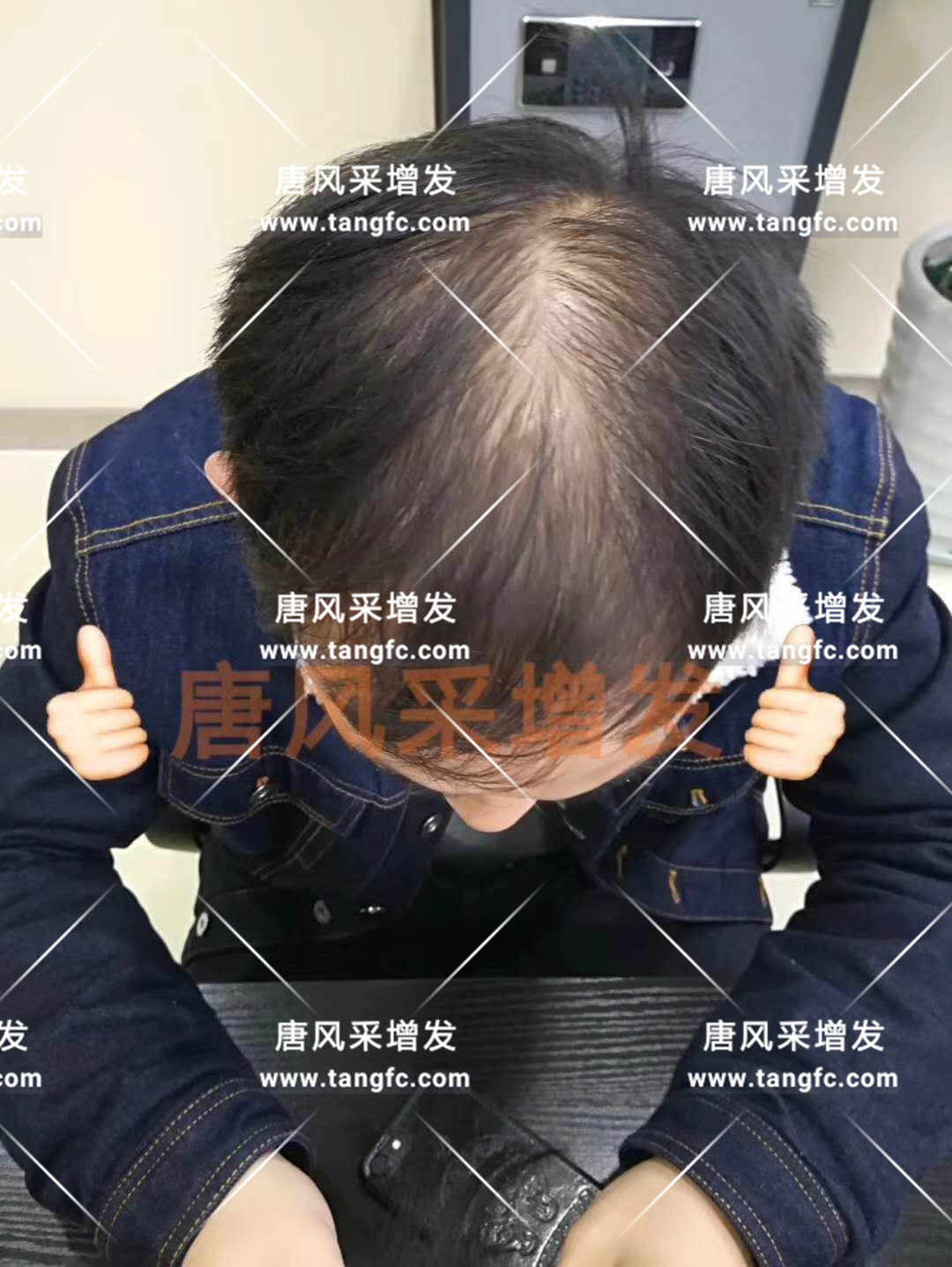 感觉自尊心好受打击，朋友说我“头上的油都够炒盘菜了...