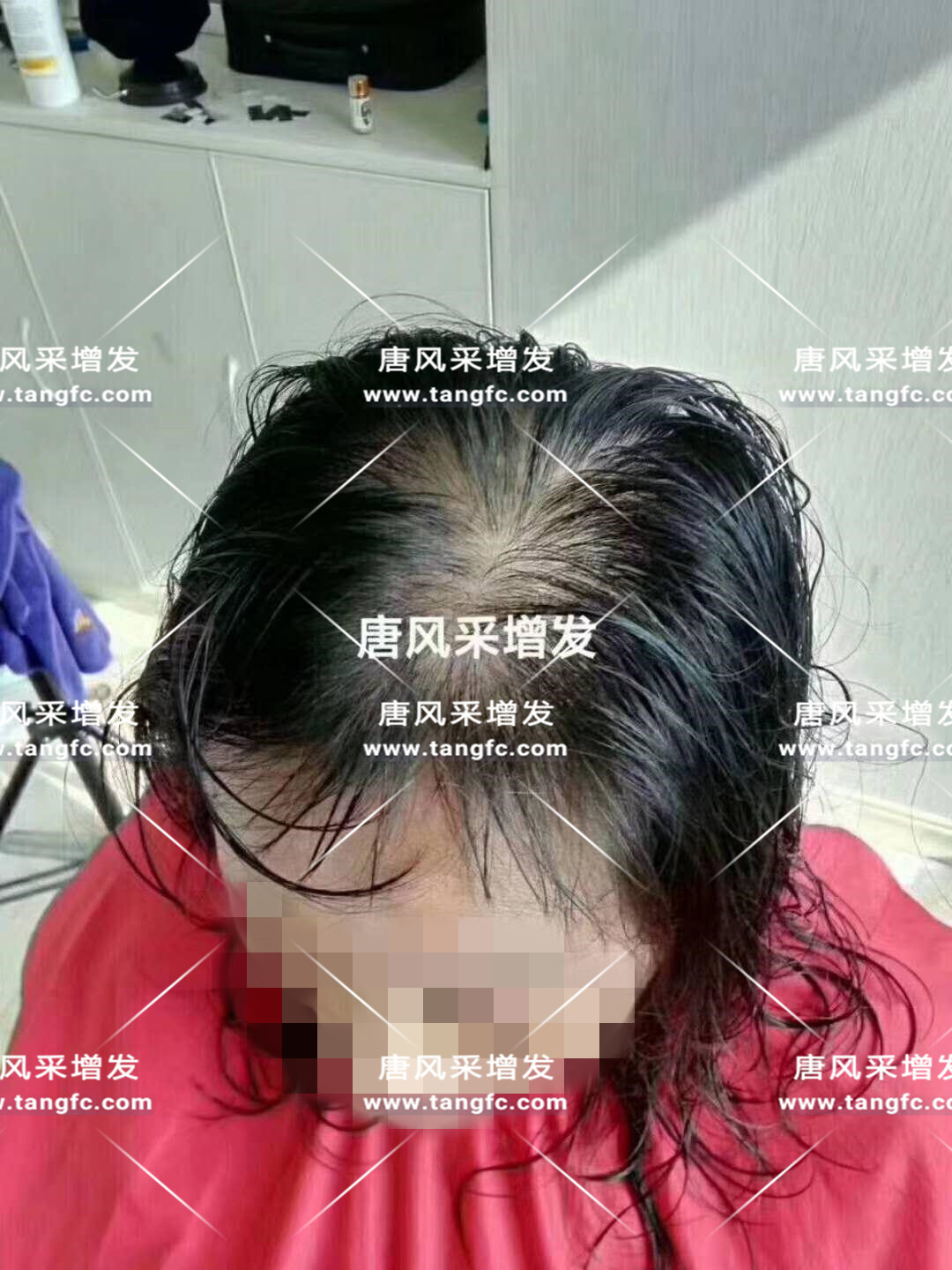 谢顶会坑一辈子？ 我不禁摸了摸自己头发