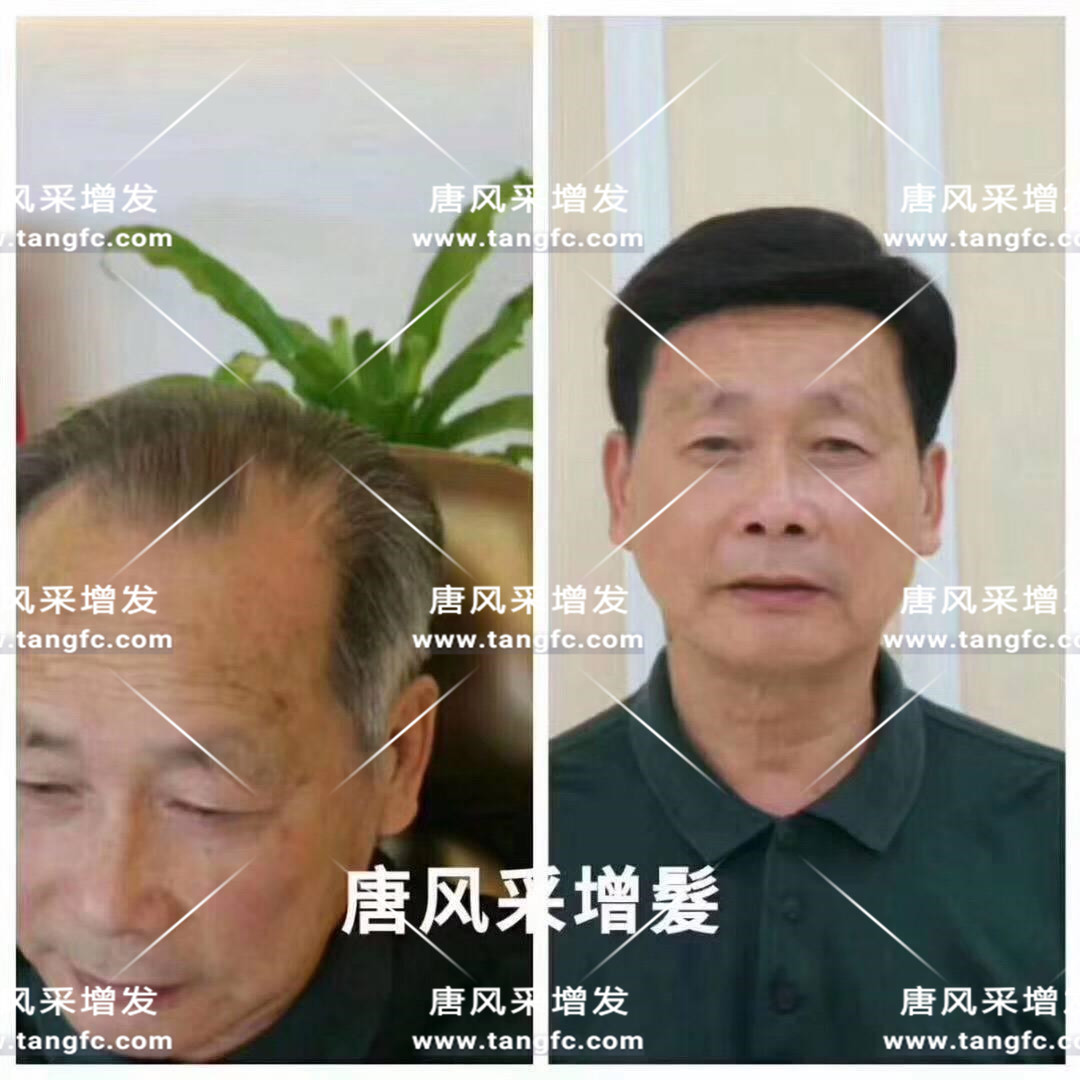 谢顶会坑一辈子？ 我不禁摸了摸自己头发