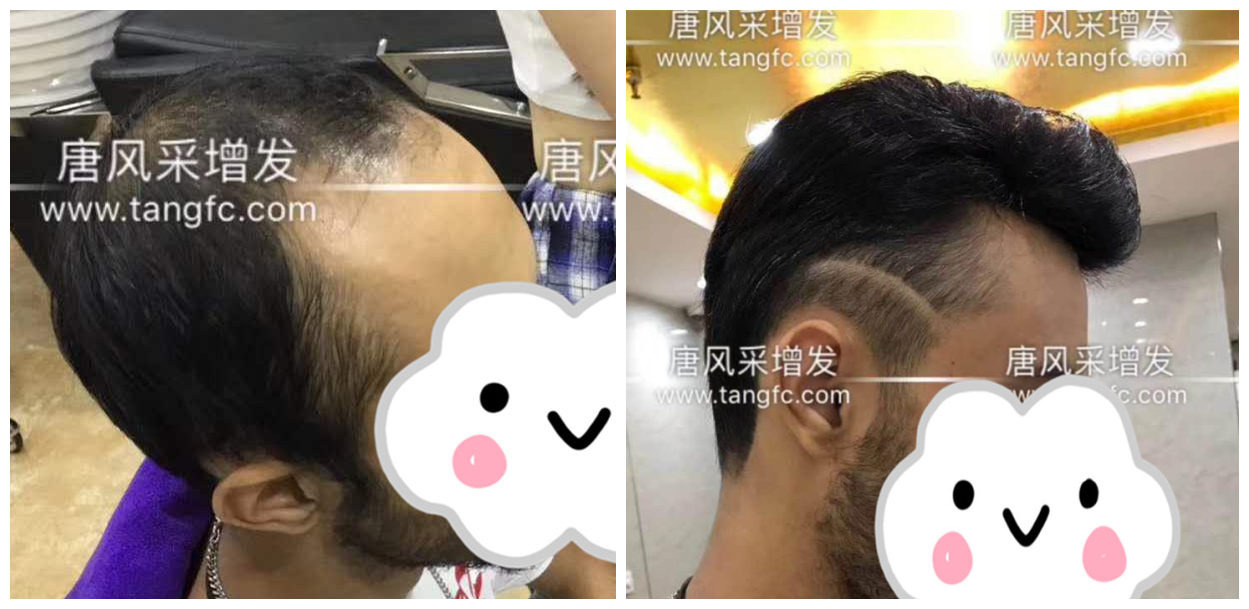 男士假发容易看出来吗？看看做过头发的发友怎么说！