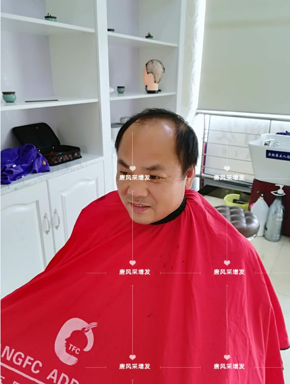 脱发 唐风采增发 脱发不分地域,唐风采增发助力北京爷们