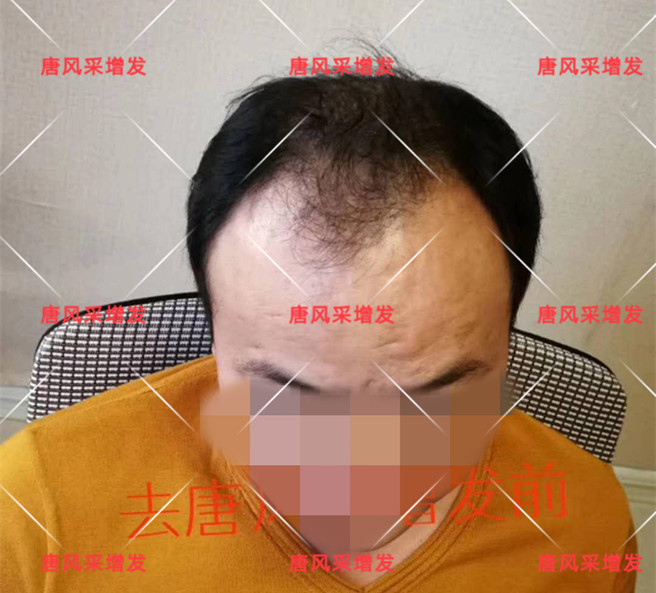 谢顶 谢顶是颜值也拯救不了的尴尬!