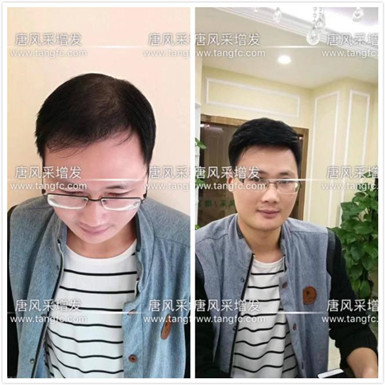 如何避免成为一个脱发的中年猥琐男人？