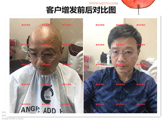 双节同庆 脱发 双节同庆,给脱发的父亲什么礼物,让父亲“年轻10岁”的神