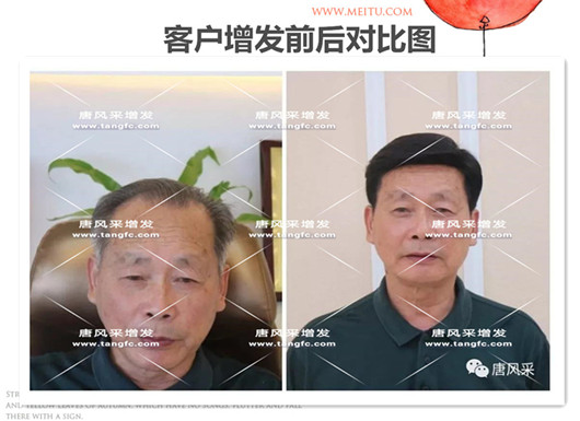 双节同庆 脱发 双节同庆,给脱发的父亲什么礼物,让父亲“年轻10岁”的神