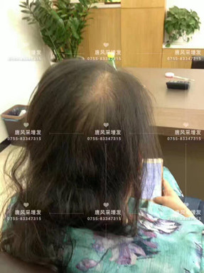 头发稀少 头发稀少了,我该拿什么来拯救你?