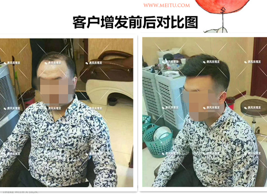 防偷防盗防不了发际线, 变秃顶了怎么办？