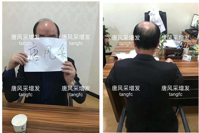 脱发可不像脱贫 唐风采增发案例 ,脱发谢顶后