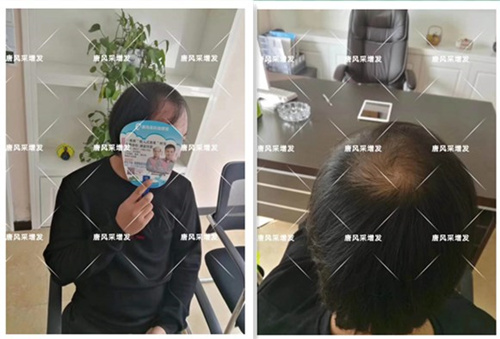 男士假发多少钱 客户脱发