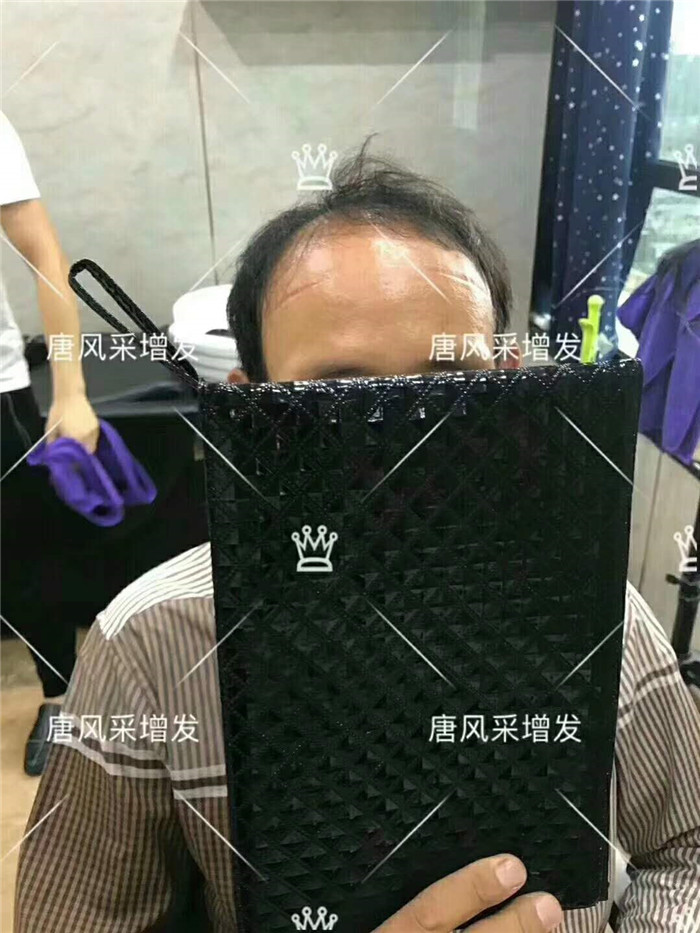 雄性激素脱发