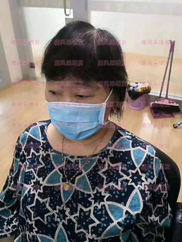 中老年女士头发稀少