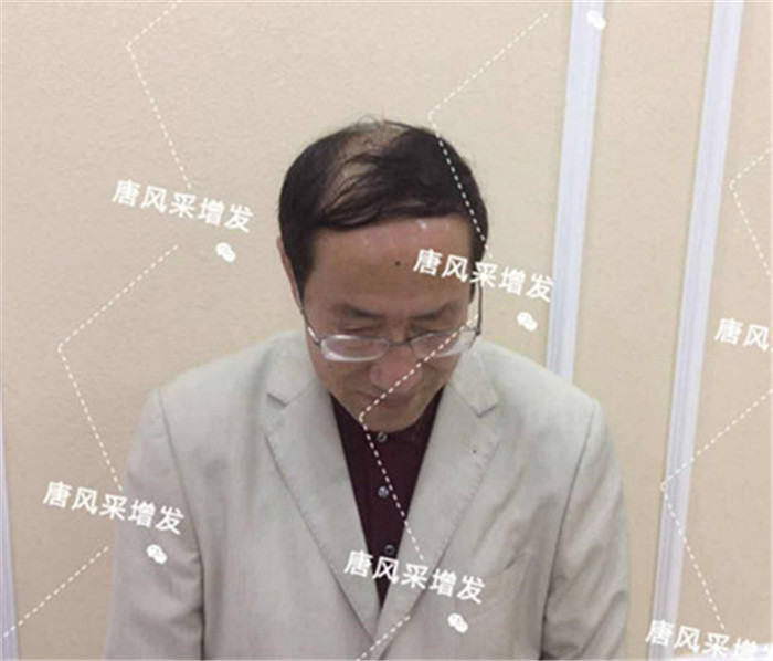 如何解决地中海脱发 谢顶