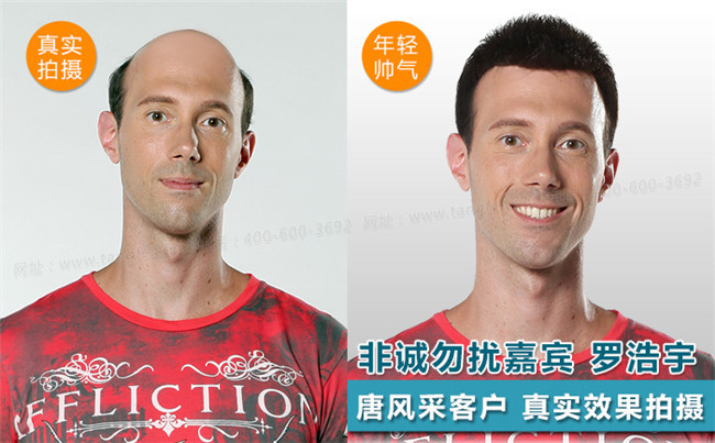 秃顶发型设计 唐风采客户