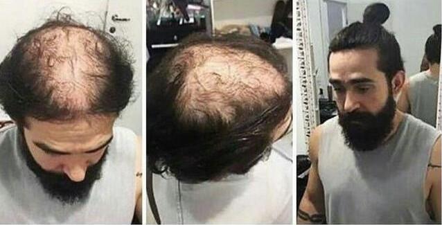 秃顶发型设计 秃顶发型设计