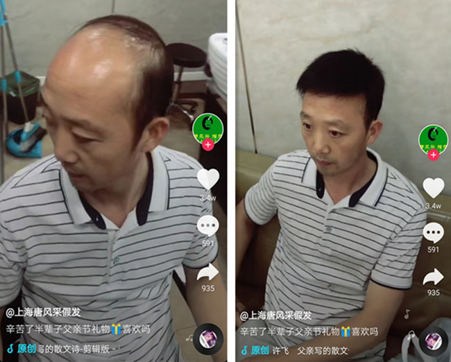头顶局部假发 唐风采客户案例