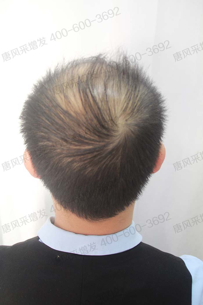 男士假发块 \