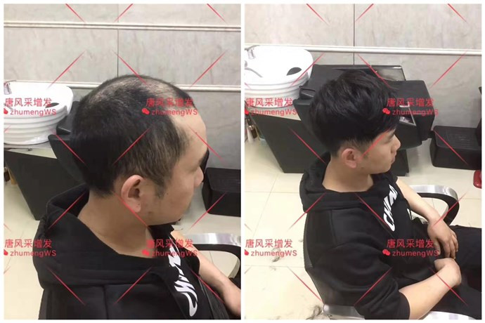 头顶的假发片 \
