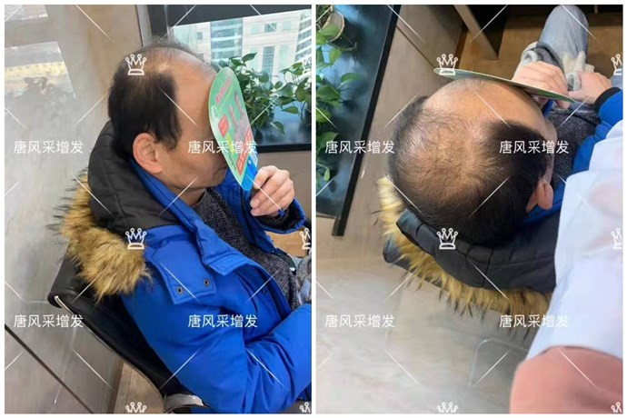 现在戴假发的人多吗 \