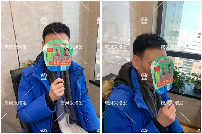 戴假发的人多吗 \