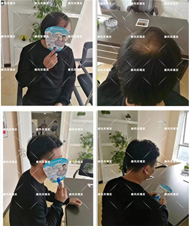戴假发的人多吗 \