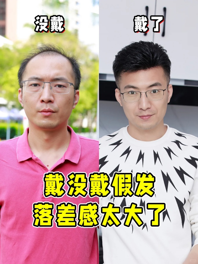 谢顶男人变帅、北京假发 \