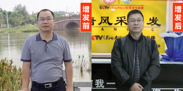 天生头发稀少怎么变浓密？补发真的管用吗