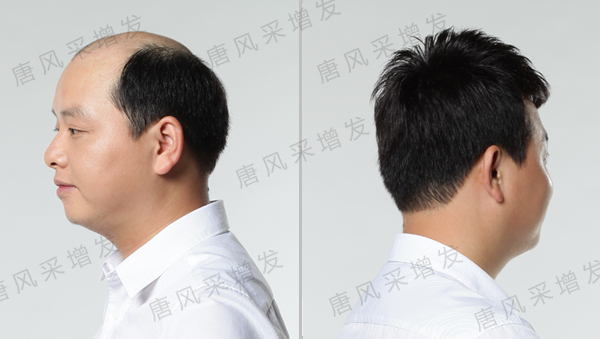 天生头发稀少怎么变浓密？补发真的管用吗