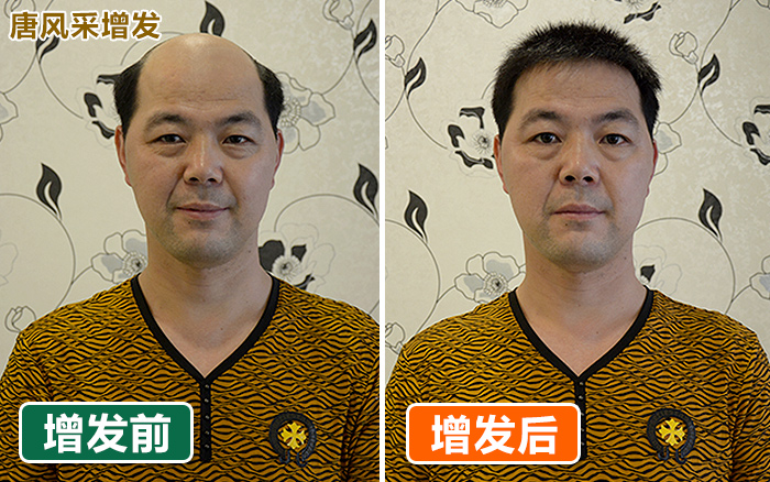 有头发和没头发之间的巨大差距 有头发和没头发之间的巨大差距,看完你就明白了!