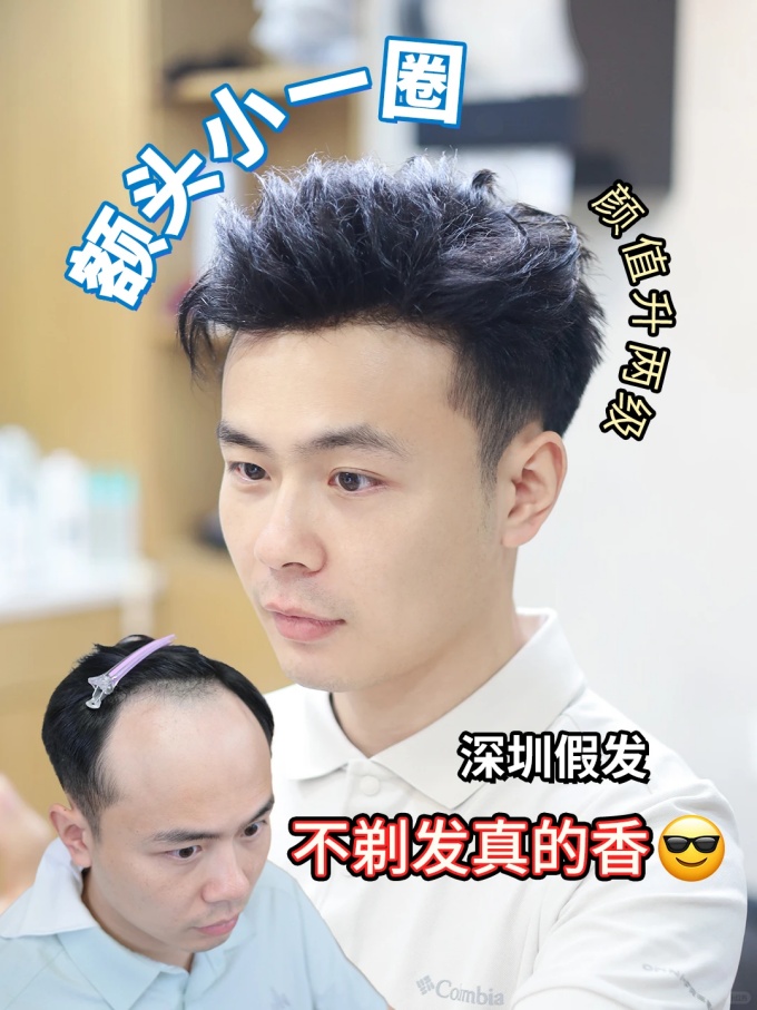 深圳假发,发际线后退 \