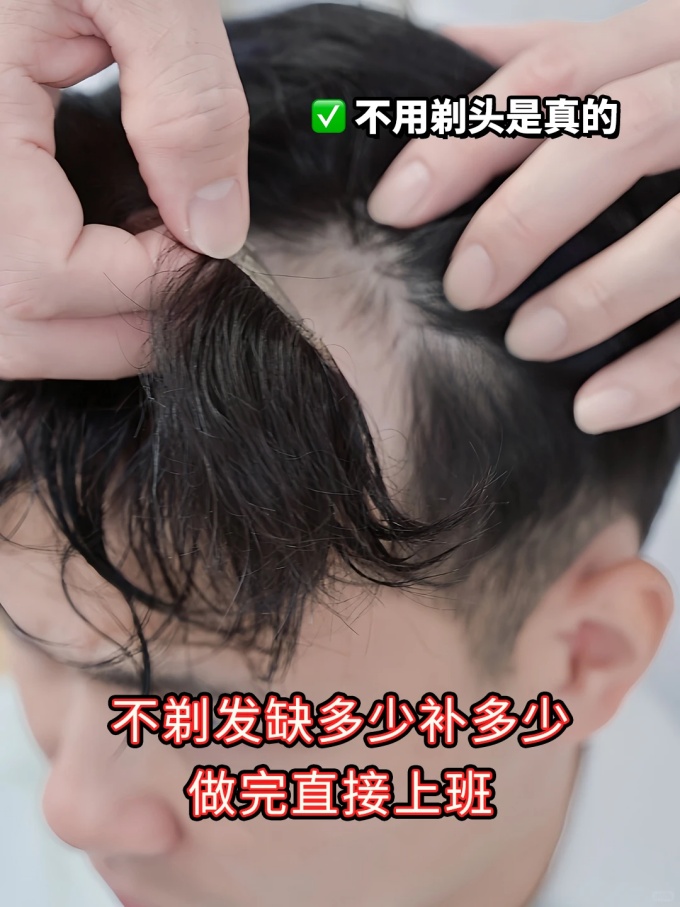 深圳假发,发际线后退 \