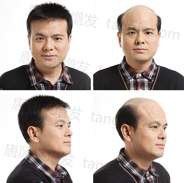 兰州织发哪里好？出现早秃的男神们注意了！