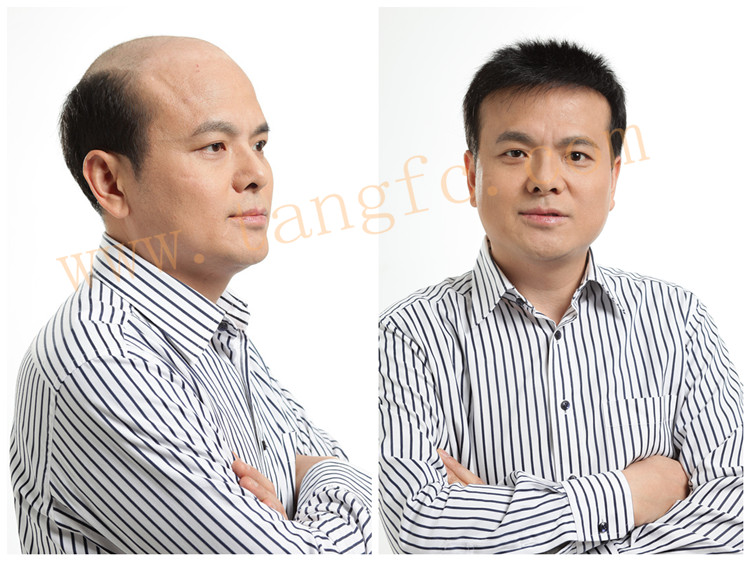 北京织发补发哪家好？怎么收费？